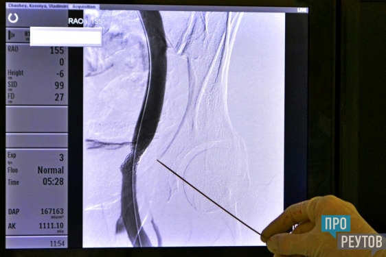 Реутовские хирурги впервые провели уникальную операцию. Стентирование левой подвздошной вены восстановило кровоток в ноге 44-летней женщины. ПроРеутов